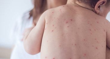 Vakalar artıyor! 1 yaş altı bebekler ağır kızamık için risk altında!