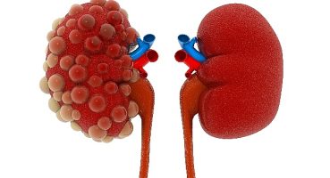 Abdi İbrahim Otsuka Medikal Direktörlüğü: Polistik Böbrek Hastalığının Seyrini Değiştirmek Mümkün