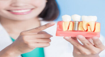 Antalya İmplant Tedavisi | Dentist Özgür Yıldırım