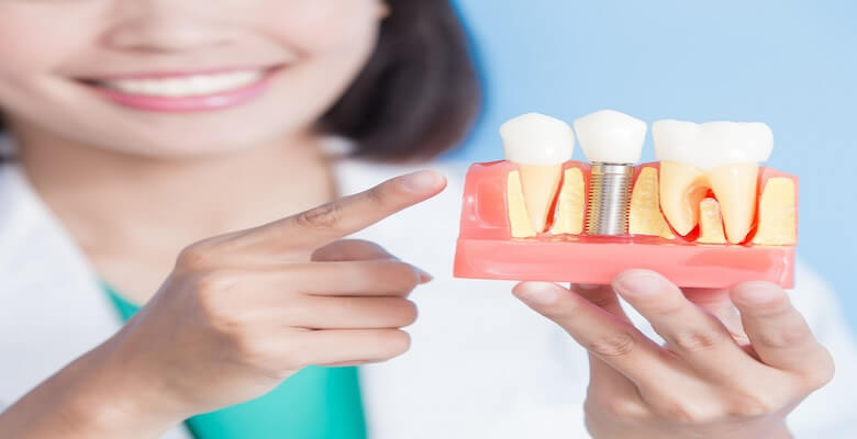 Antalya İmplant Tedavisi | Dentist Özgür Yıldırım