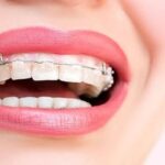 Diş Teli Tedavisinde Dikkat Edilecek Noktalar