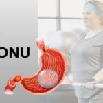 Yutulan Mide Balonu Fiyat