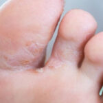 Mantar Enfeksiyonu Nedir? Mantar Enfeksiyonlarının Nedenleri