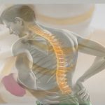 Ağrısız Dönem Aldatıcıdır: Bel Fıtığı Ameliyatı Sonrası Neden Tekrarlar?